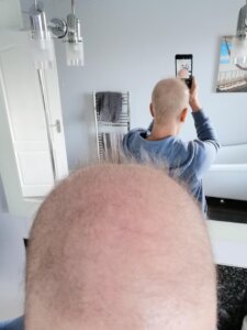 Karen's hair loss (caused by chemo) affected her confidence deeply